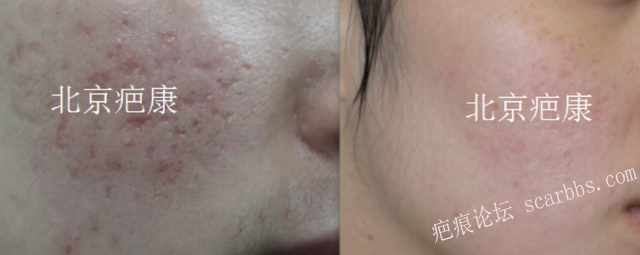 凹陷型痘疤的种类有哪些？应该如何治疗？