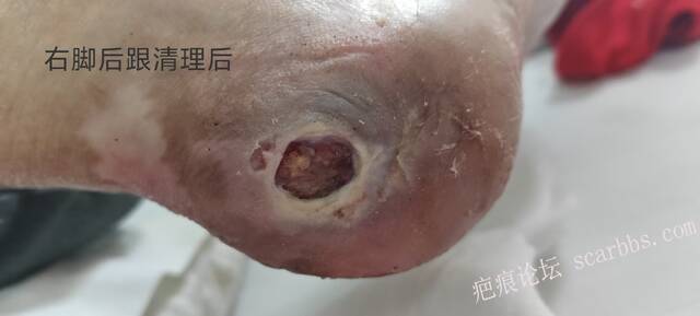 2025年李高令接治2023年低温烫伤的老人（青岛） 