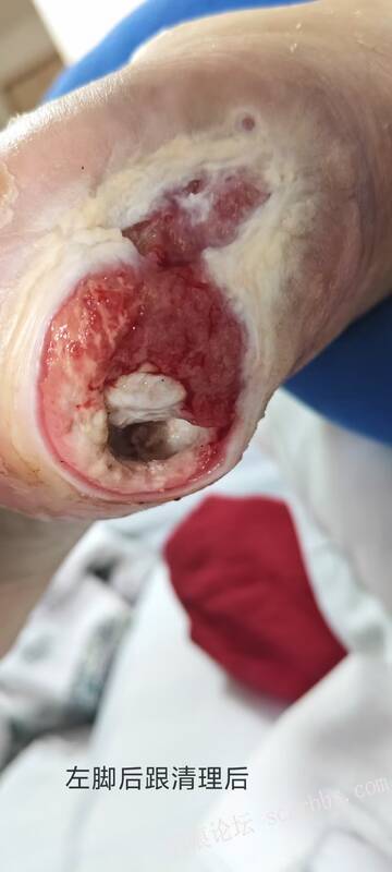 2025年李高令接治2023年低温烫伤的老人（青岛） 