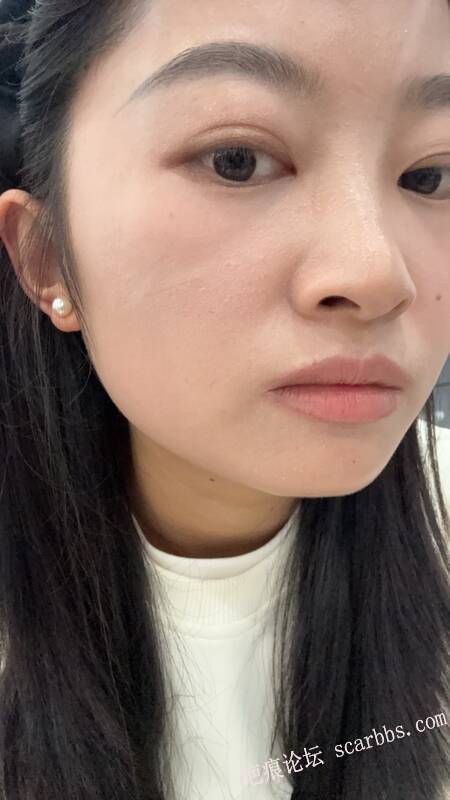 面部凹陷疤痕，今天才做完手术 