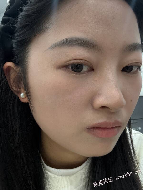 面部凹陷疤痕，今天才做完手术 