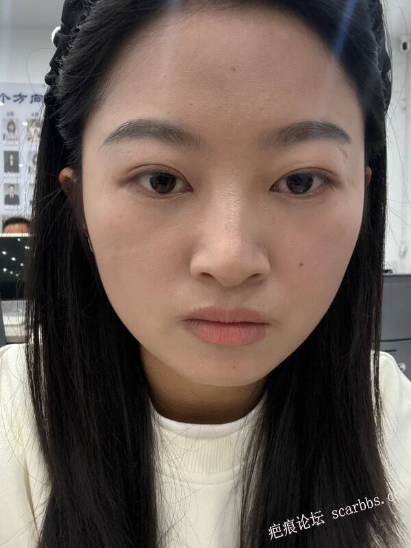 面部凹陷疤痕，今天才做完手术 