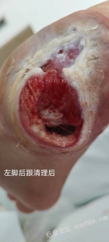 2025年李高令接治2023年低温烫伤的老人（青岛） 