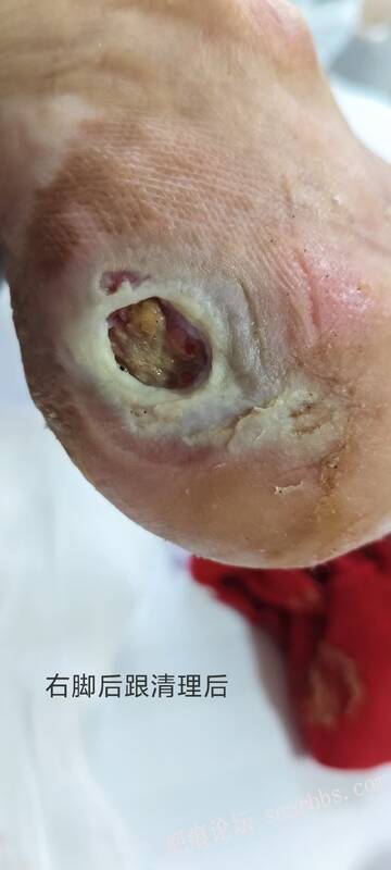 2025年李高令接治2023年低温烫伤的老人（青岛） 