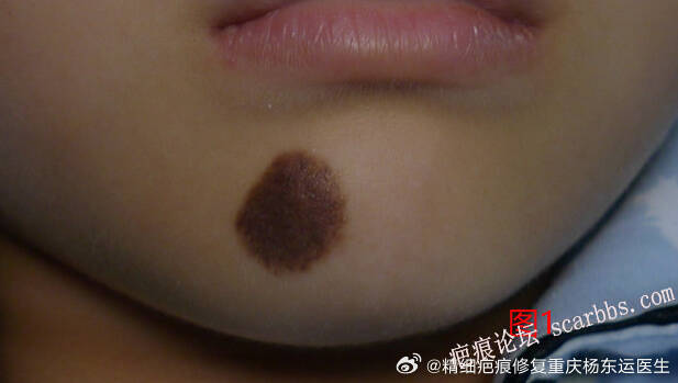 #祛痣#精细疤痕修复#美容缝合