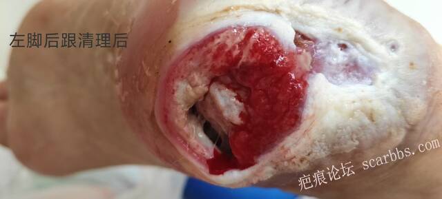 2025年李高令接治2023年低温烫伤的老人（青岛） 