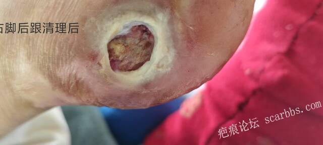 2025年李高令接治2023年低温烫伤的老人（青岛） 