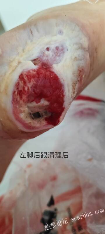 2025年李高令接治2023年低温烫伤的老人（青岛） 