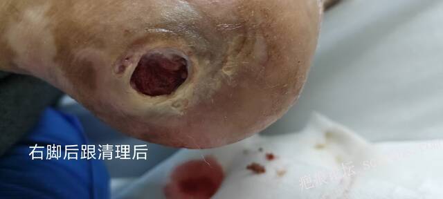 2025年李高令接治2023年低温烫伤的老人（青岛） 