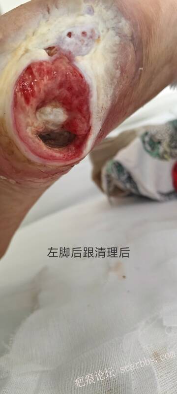 2025年李高令接治2023年低温烫伤的老人（青岛） 