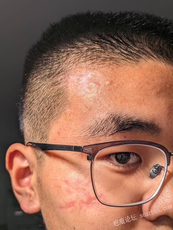 脸颊和额头的疤痕