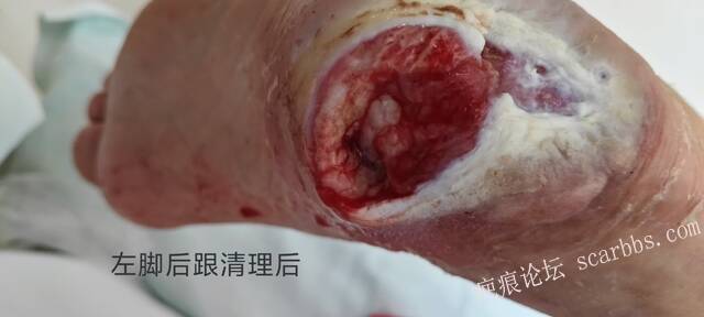 2025年李高令接治2023年低温烫伤的老人（青岛） 