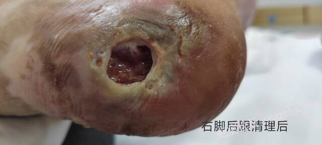 2025年李高令接治2023年低温烫伤的老人（青岛） 