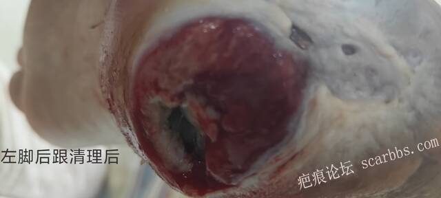 2025年李高令接治2023年低温烫伤的老人（青岛） 