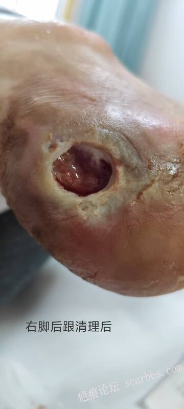 2025年李高令接治2023年低温烫伤的老人（青岛） 