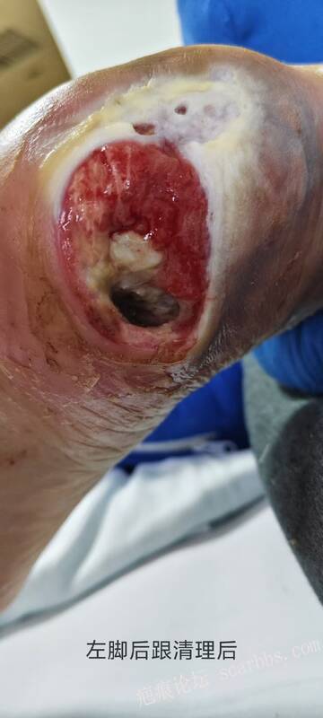 2025年李高令接治2023年低温烫伤的老人（青岛） 