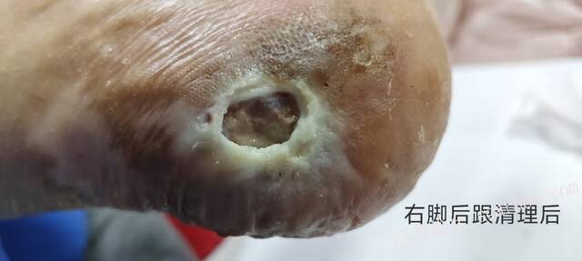 2025年李高令接治2023年低温烫伤的老人（青岛） 