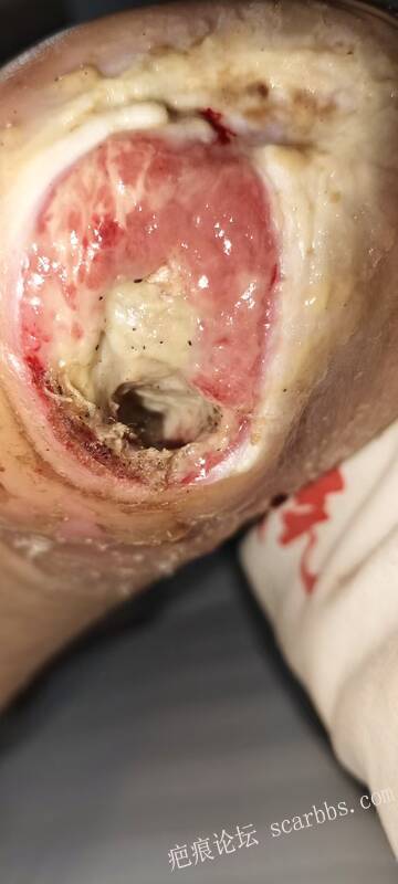 2025年李高令接治2023年低温烫伤的老人（青岛） 