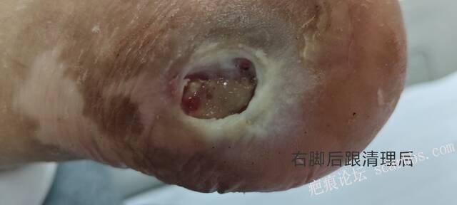 2025年李高令接治2023年低温烫伤的老人（青岛） 