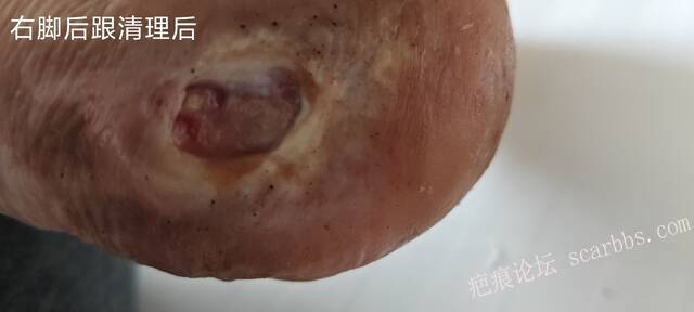 2025年李高令接治2023年低温烫伤的老人（青岛） 
