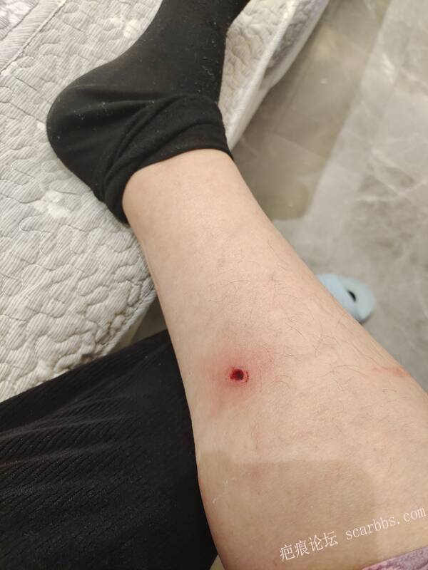 李高令说…天冷了、低温烫伤患者会逐步增多(希能引起注意) 