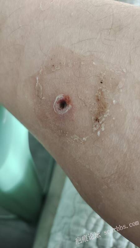 李高令说…天冷了、低温烫伤患者会逐步增多(希能引起注意) 