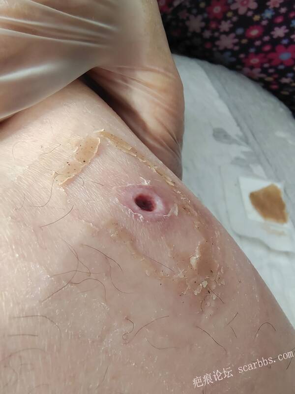 李高令说…天冷了、低温烫伤患者会逐步增多(希能引起注意) 