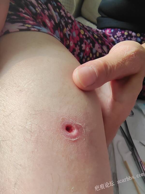 李高令说…天冷了、低温烫伤患者会逐步增多(希能引起注意) 