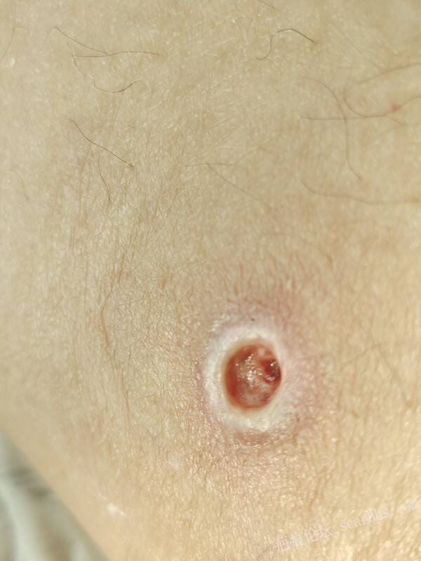 李高令说…天冷了、低温烫伤患者会逐步增多(希能引起注意) 