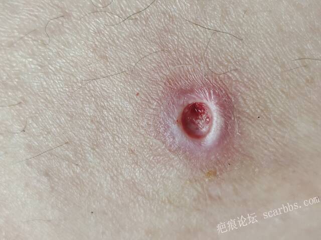 李高令说…天冷了、低温烫伤患者会逐步增多(希能引起注意) 