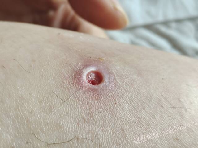 李高令说…天冷了、低温烫伤患者会逐步增多(希能引起注意) 