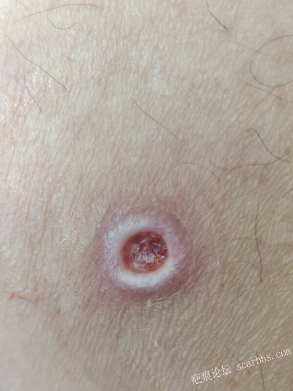 李高令说…天冷了、低温烫伤患者会逐步增多(希能引起注意) 