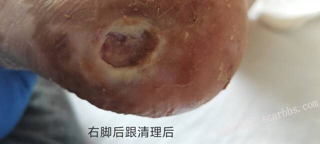 2025年李高令接治2023年低温烫伤的老人（青岛） 