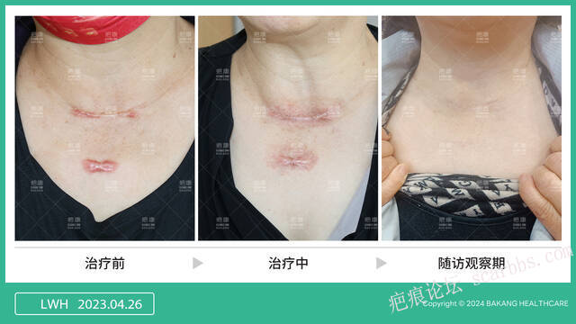 疤痕疙瘩不做浅放治疗行不行？