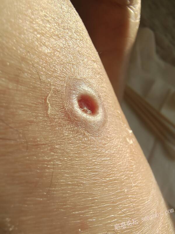 李高令说…天冷了、低温烫伤患者会逐步增多(希能引起注意) 