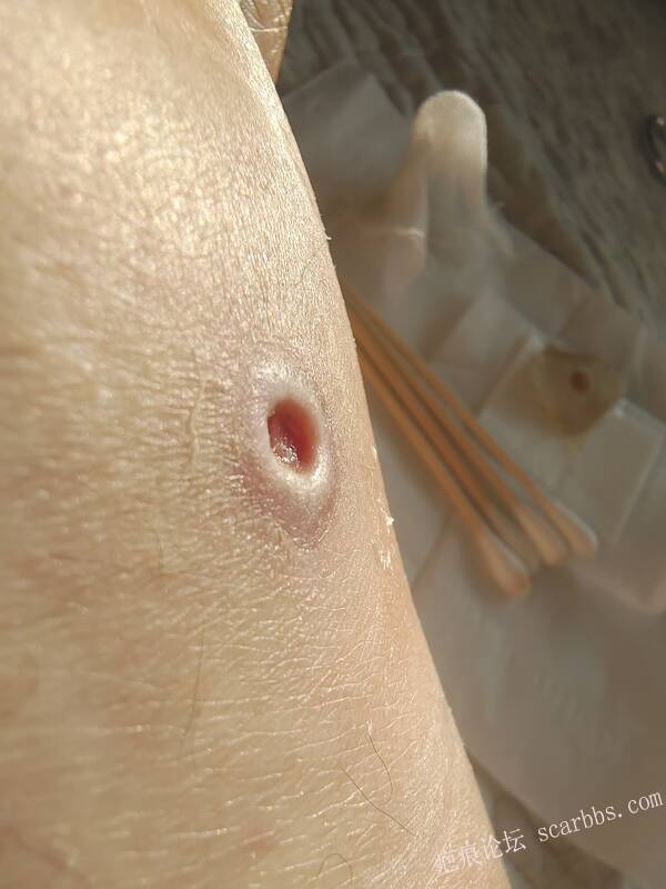 李高令说…天冷了、低温烫伤患者会逐步增多(希能引起注意) 