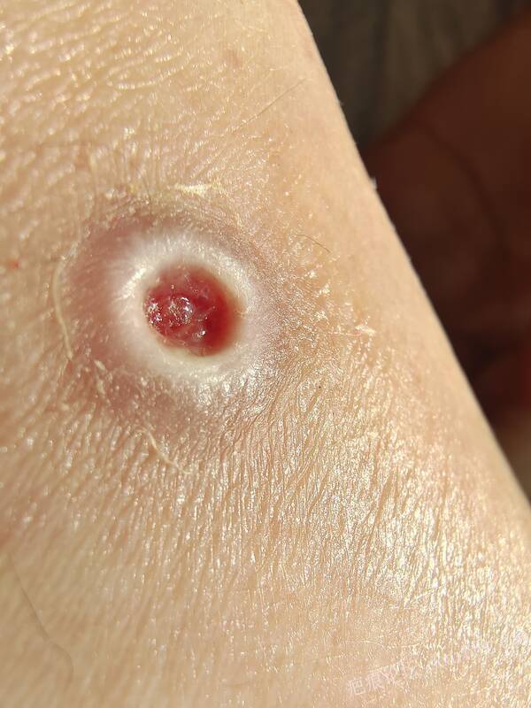 李高令说…天冷了、低温烫伤患者会逐步增多(希能引起注意) 