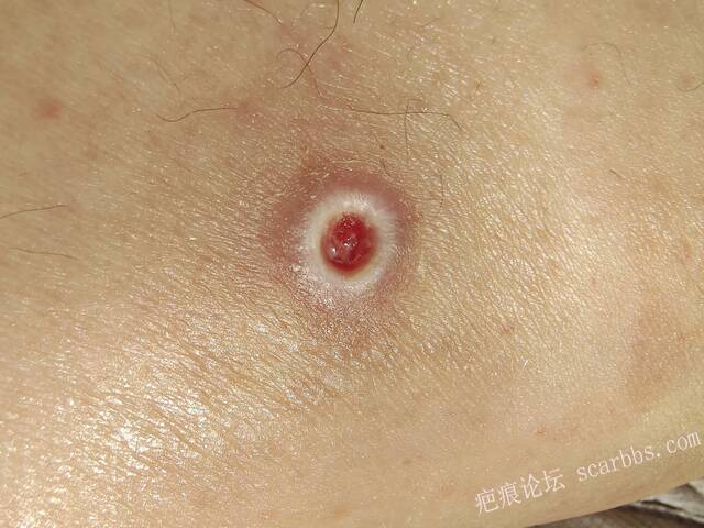 李高令说…天冷了、低温烫伤患者会逐步增多(希能引起注意) 