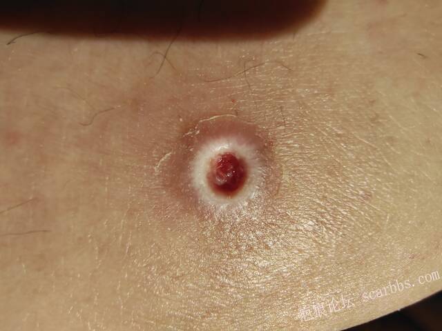 李高令说…天冷了、低温烫伤患者会逐步增多(希能引起注意) 