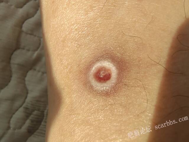 李高令说…天冷了、低温烫伤患者会逐步增多(希能引起注意) 