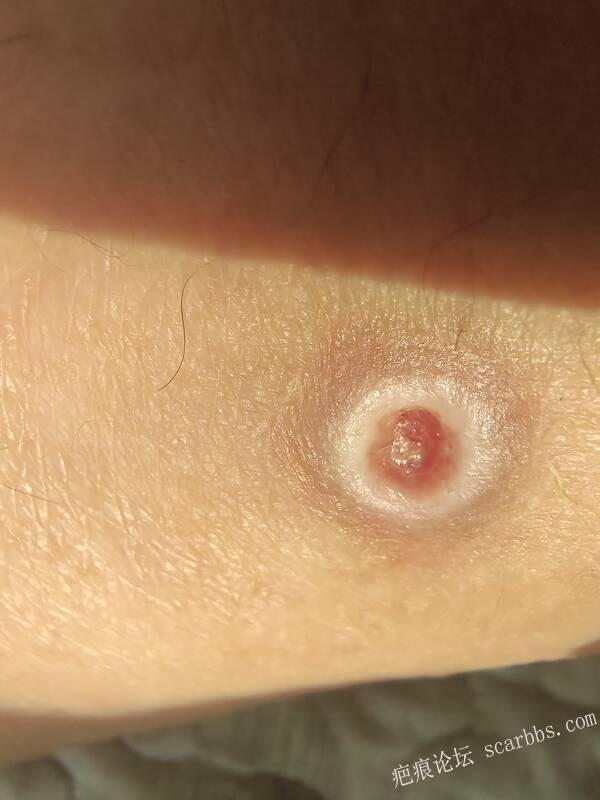 李高令说…天冷了、低温烫伤患者会逐步增多(希能引起注意) 