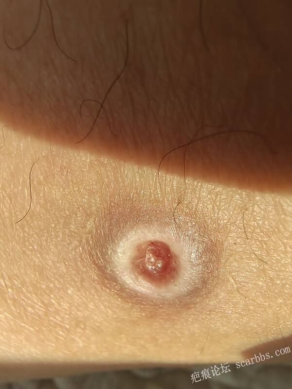 李高令说…天冷了、低温烫伤患者会逐步增多(希能引起注意) 