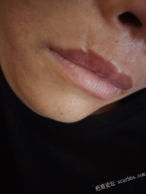 八大处哪个医生专业切缝唇疤痕？