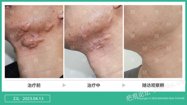 疤痕疙瘩里的白色分泌物千万不要挤！