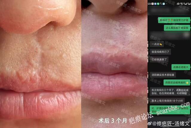 上唇疤痕切除缝合术后3月