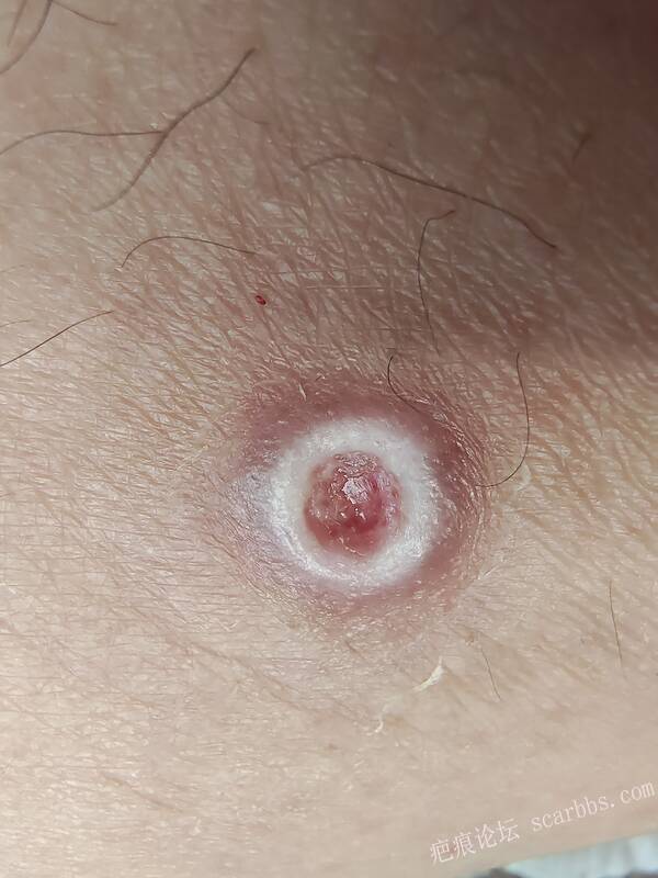 李高令说…天冷了、低温烫伤患者会逐步增多(希能引起注意) 