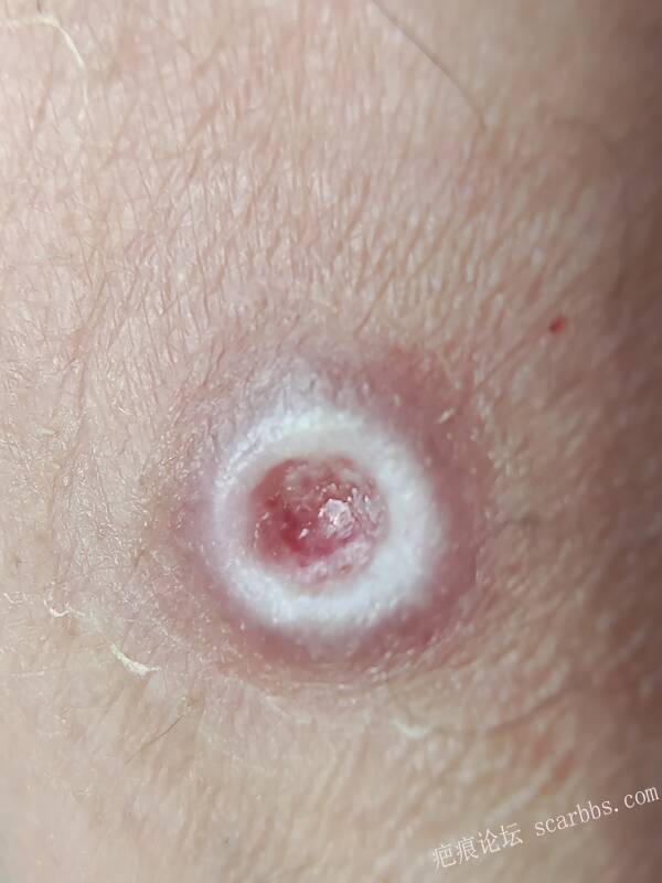 李高令说…天冷了、低温烫伤患者会逐步增多(希能引起注意) 