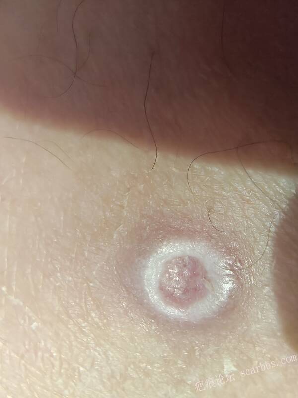 李高令说…天冷了、低温烫伤患者会逐步增多(希能引起注意) 