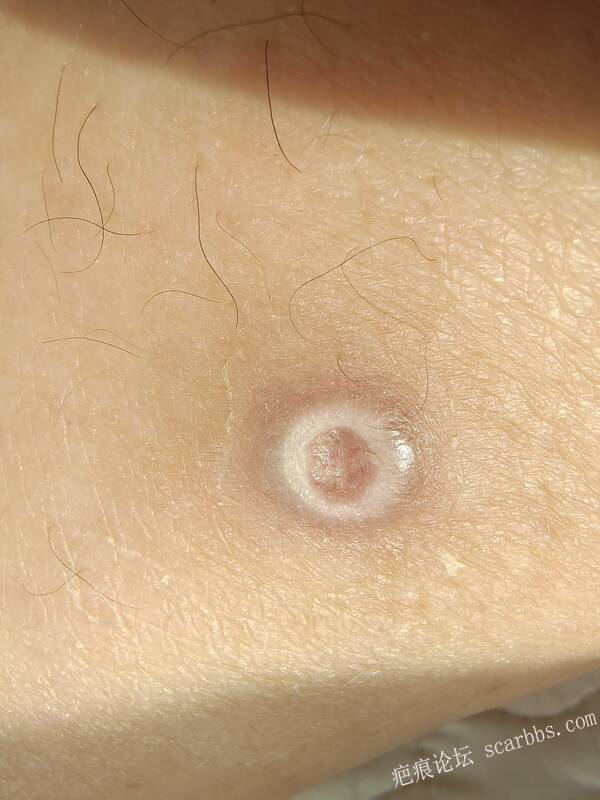 李高令说…天冷了、低温烫伤患者会逐步增多(希能引起注意) 