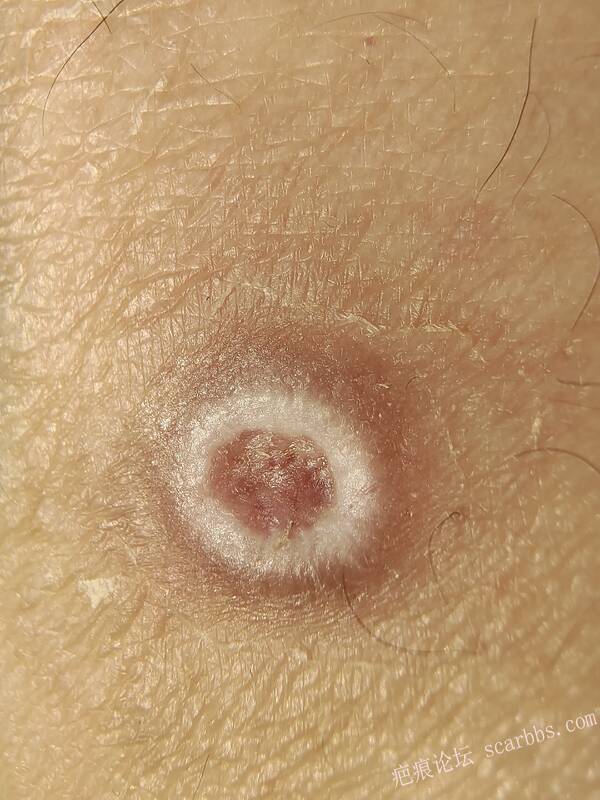 李高令说…天冷了、低温烫伤患者会逐步增多(希能引起注意) 